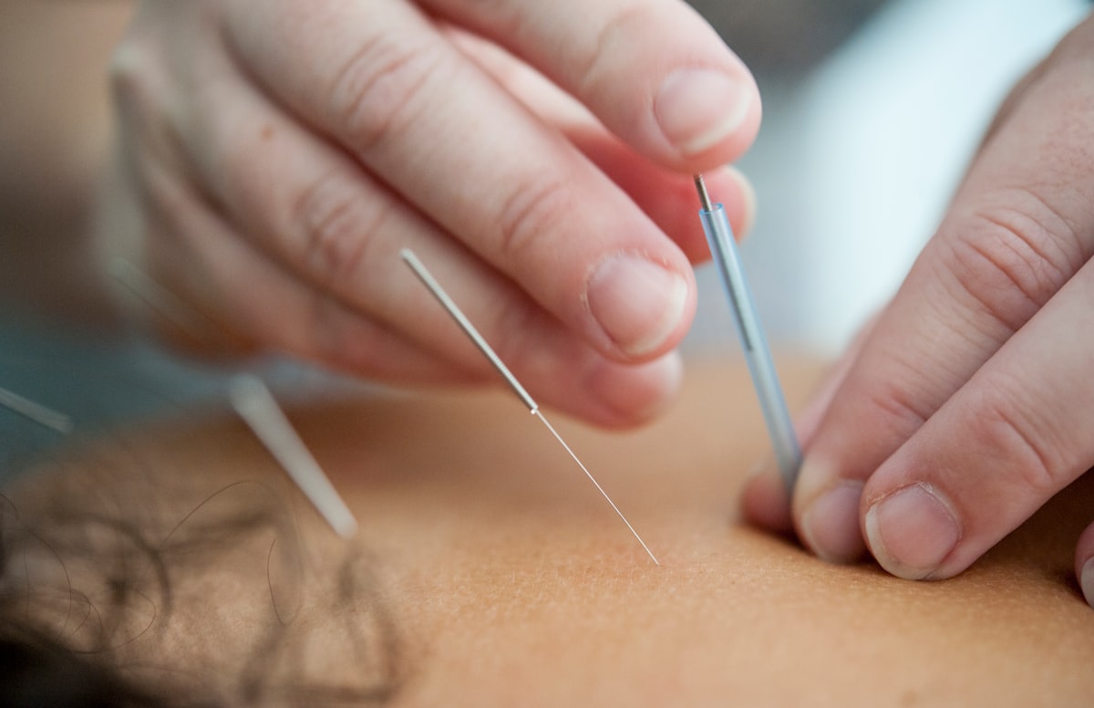 Traditional Chinese herbal medicine and acupuncture tools